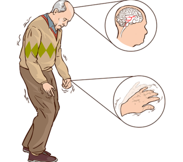 Old man with parkinson symptoms 360x320